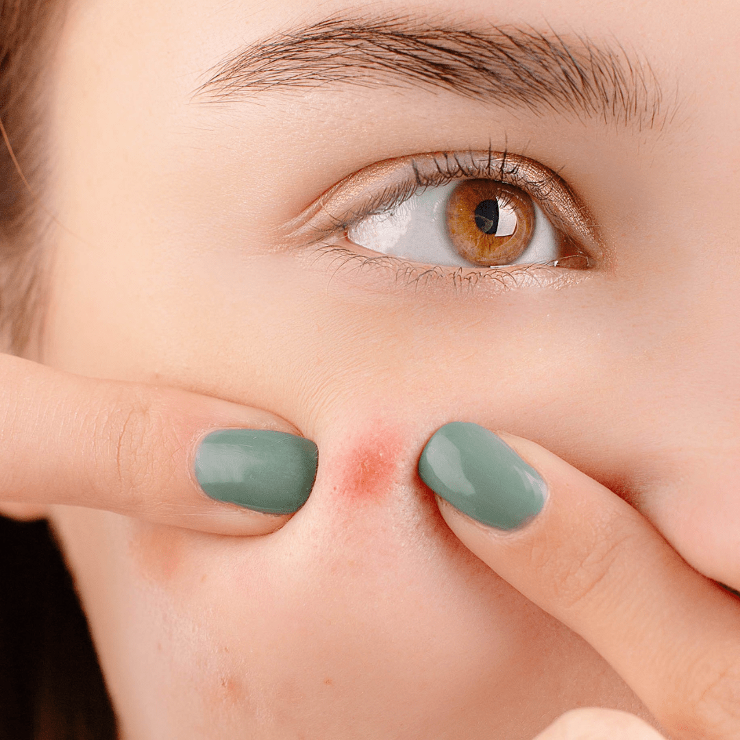 Pimple & Spot Patches Magic Dots - Pack of 36 Hydrocolloid Pimple Patch Spot Treatment